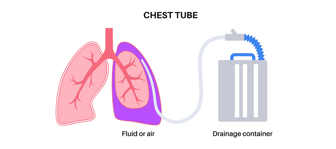 Chest Tube Insertion Procedure