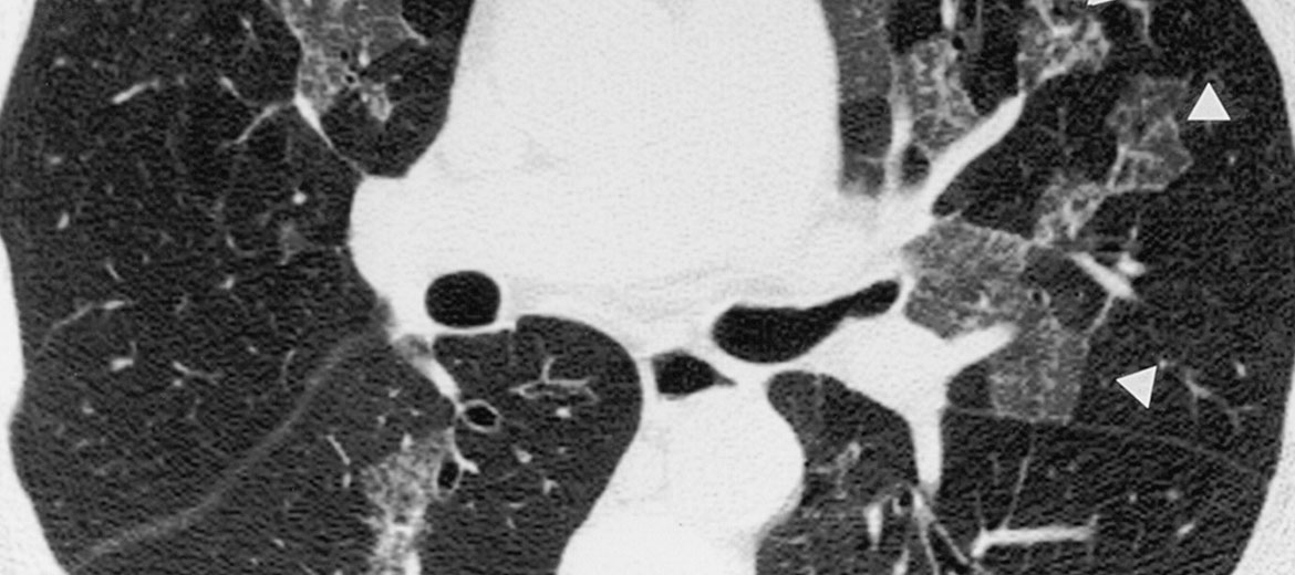 HRCT Chest Scan