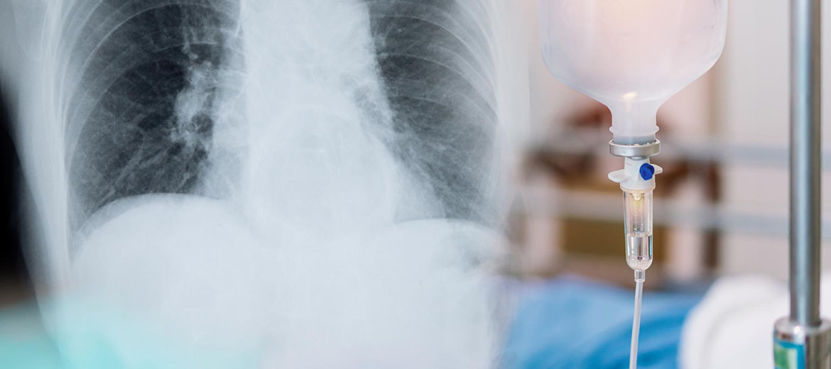 Pleural Effusion Treatment