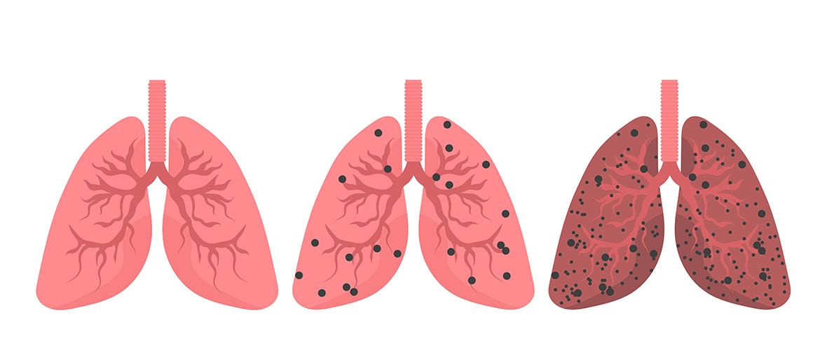 Pneumothorax Treatment